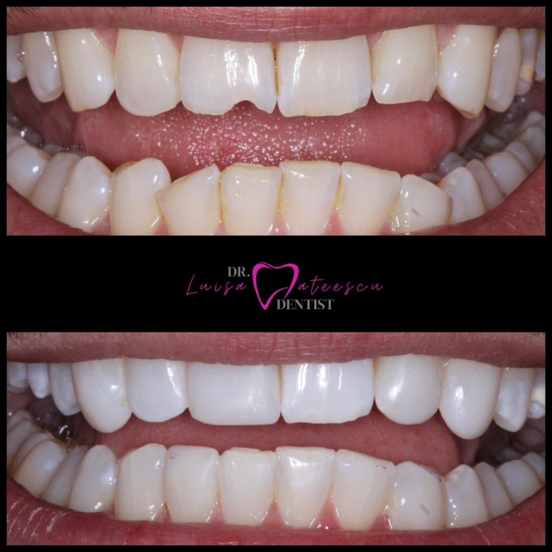 Before and After Teeth Whitening Treatment Teeth