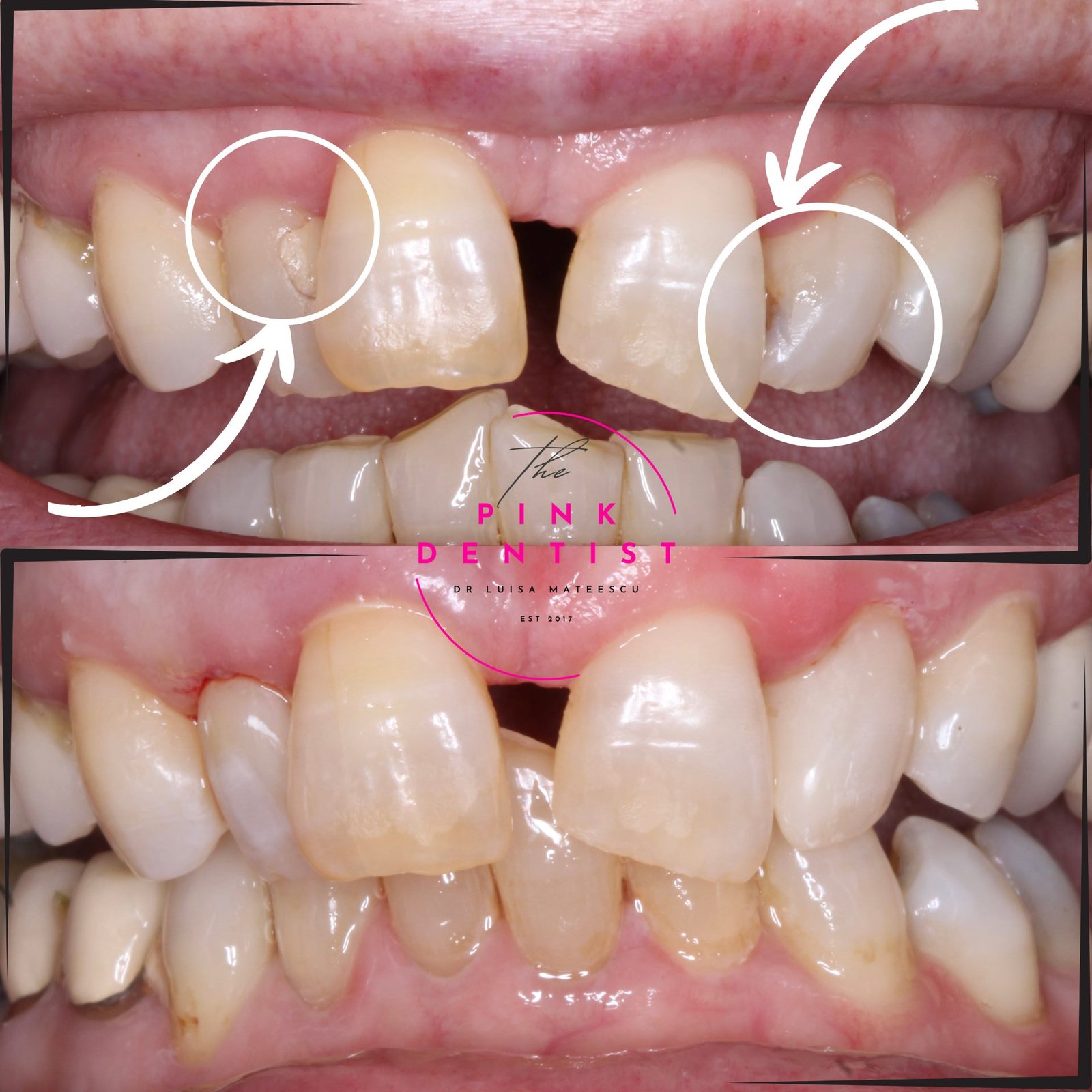Before and After Teeth Whitening Treatment Teeth