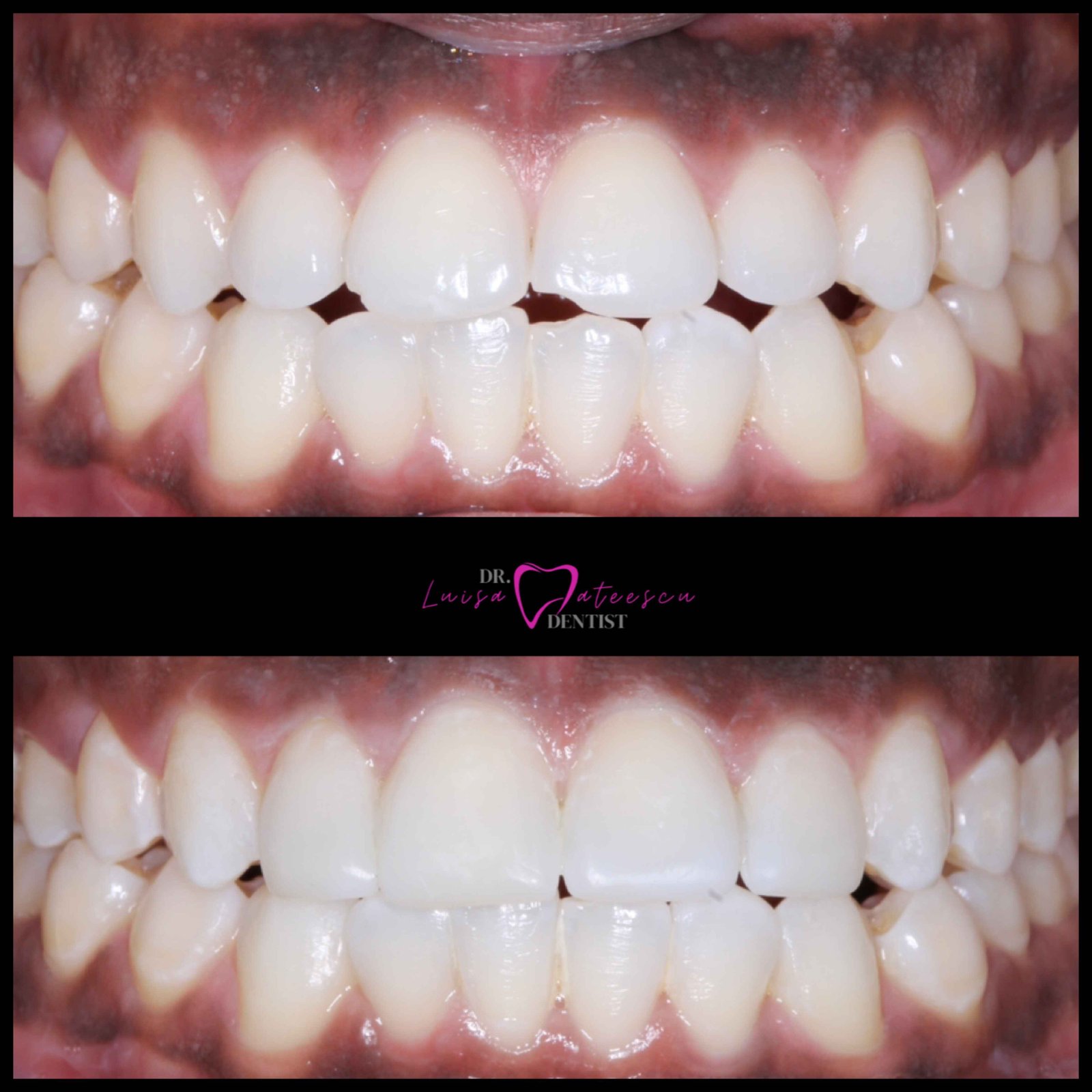 Before and After Dr Luisa Patients