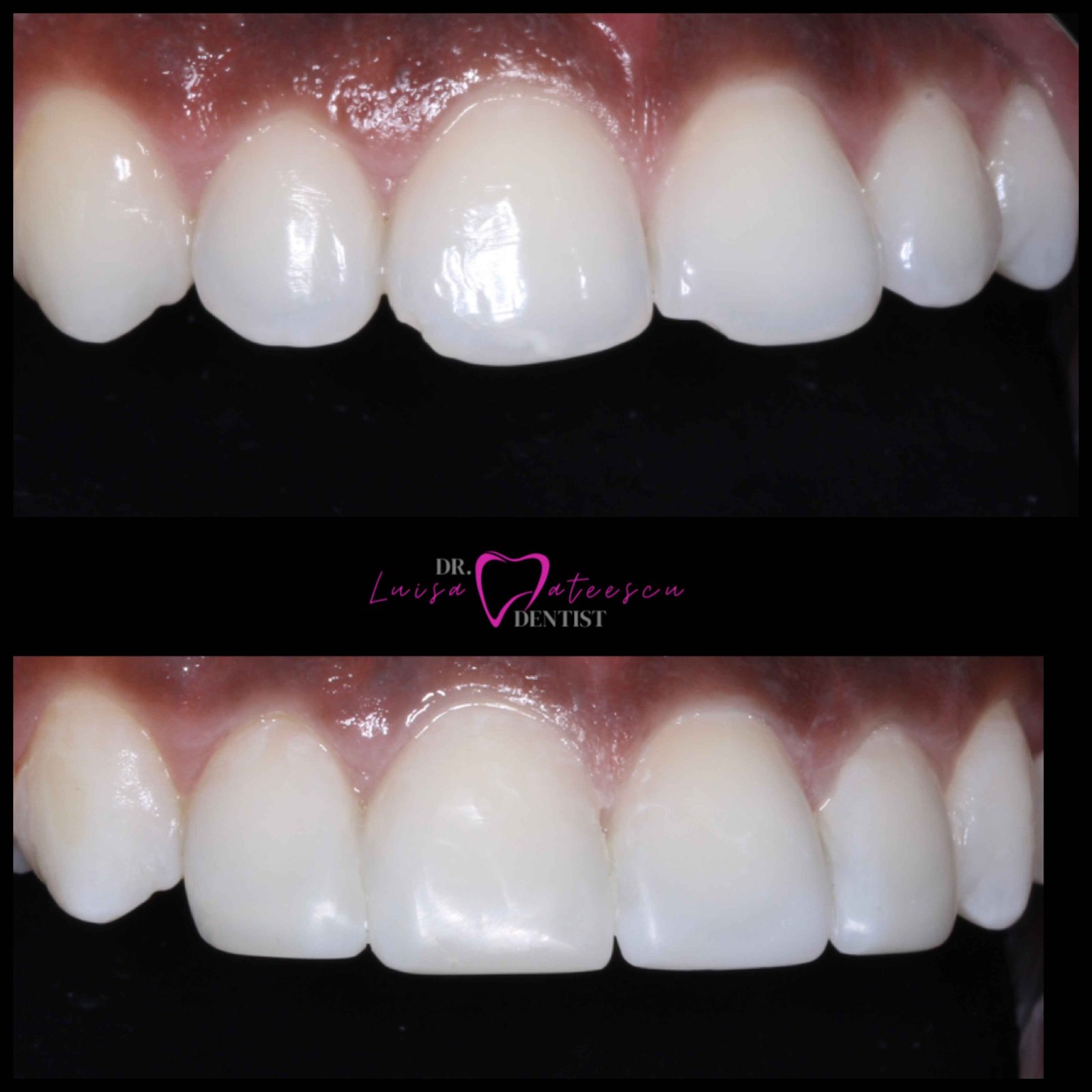 Before and After Dr Luisa Patients