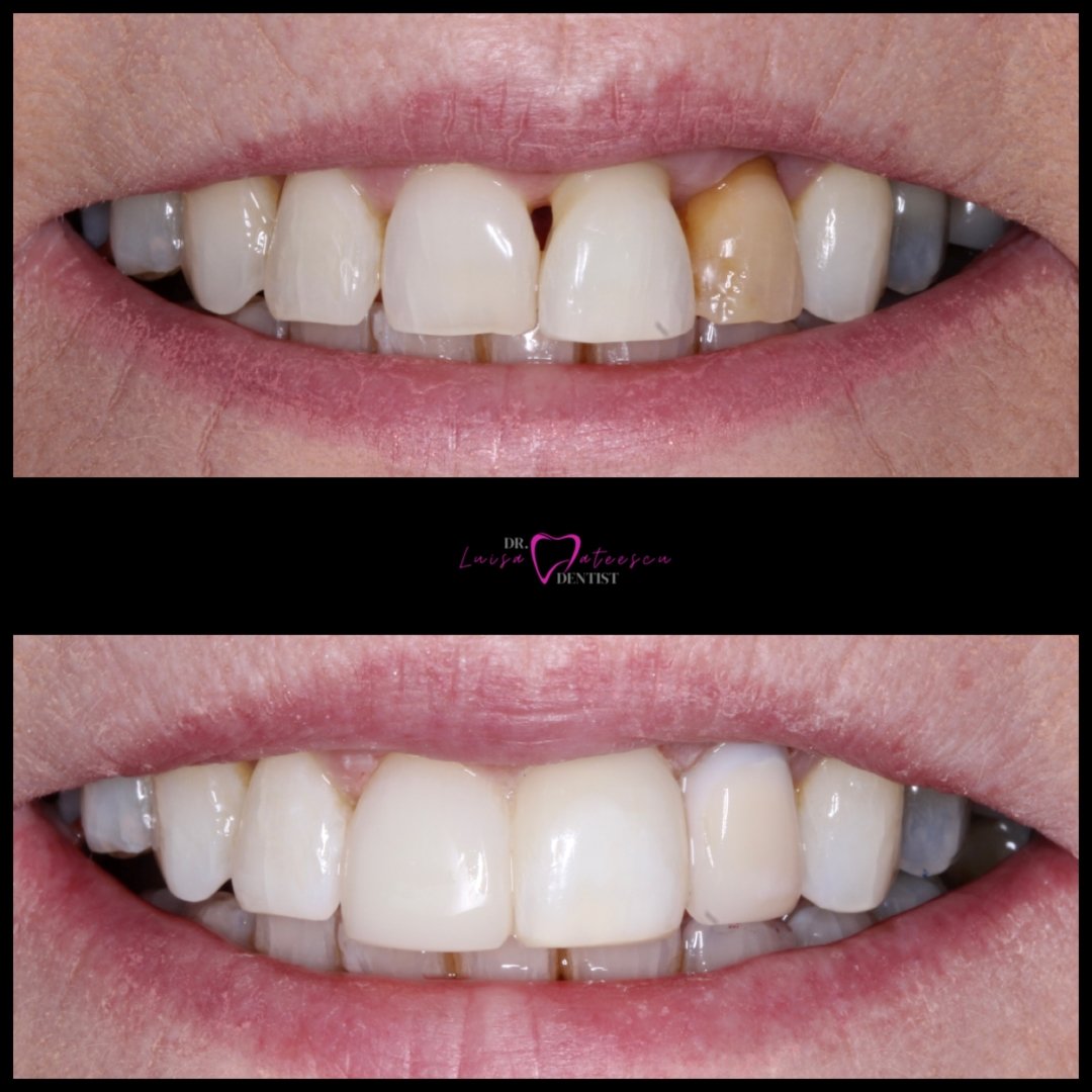 Before and After Teeth Whitening Treatment Teeth