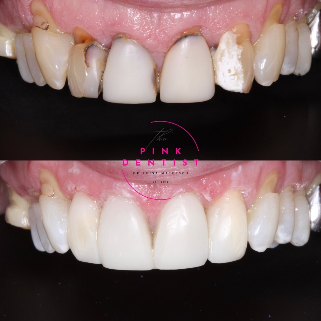 Before and After Dr Luisa Patients