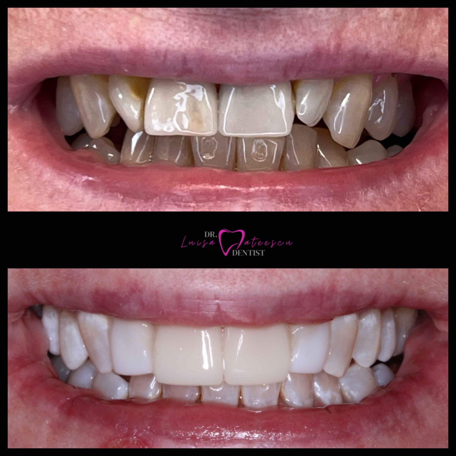 Before and After Dr Luisa Patients